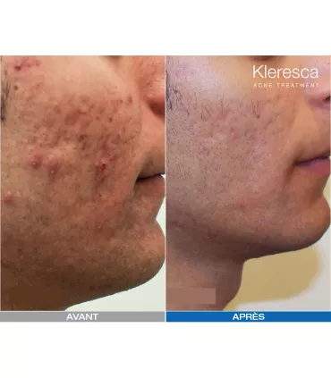 Kleresca • FB Dermatology